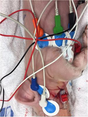 Neonatal Impedance Cardiography in Asphyxiated Piglets—A Feasibility Study